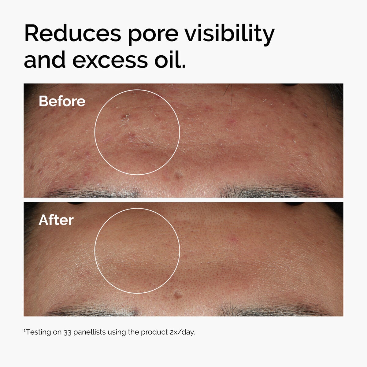 niacinamide-10-zinc-1-v1 ord-niacinamide-zinc-blemish-serum-before-after-pores.jpg
