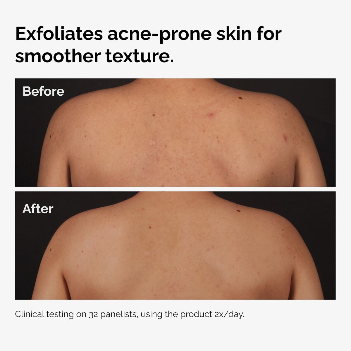 salicylic-acid-0-5-body-serum-w1 ord-salicylic-acid-body-serum-before-after-graphic-NA.jpg