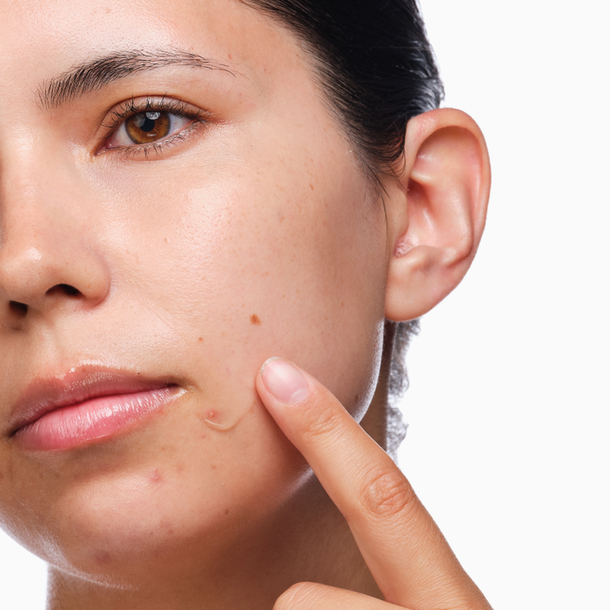 the-acne-set-n8 rdn-the-acne-set-application.png